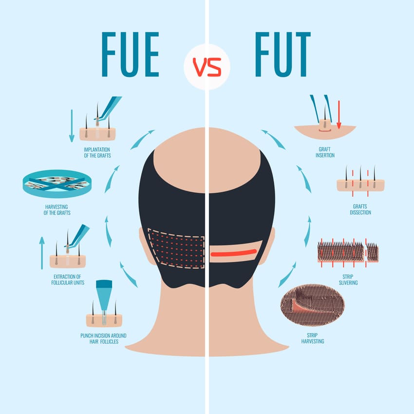 תרשים כדי להבין את ההבדל בין השתלת FUE והשתלת FUT