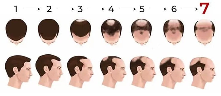 תרשים של סולם ההתקרחות של נורווד