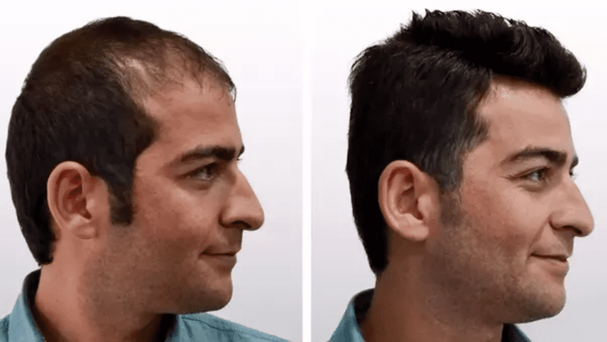 תמונה לפני ואחרי השתלת שיער בטורקיה